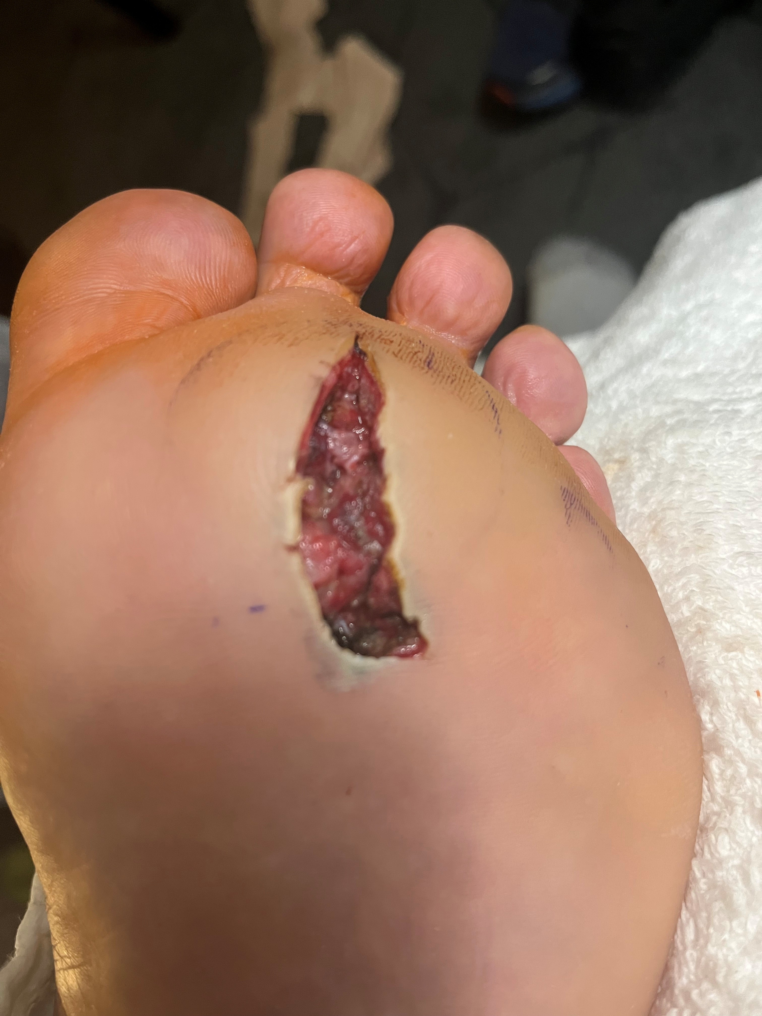 Initial diabetic foot ulcer prior to treatment